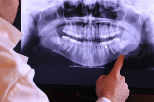 Best Knocked-Out Tooth (Avulsed Tooth) Treatment in University Park, IL